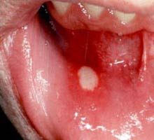 Canker - HIPERnatural.COM