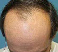 Alopecia - HIPERnatural.COM
