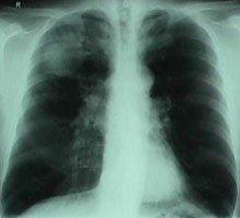 Pulmonaryemphysema - HIPERnatural.COM