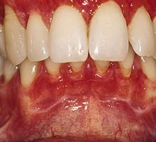 Gingivitis - HIPERnatural.COM