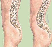 LORDOSIS - HIPERnatural.COM